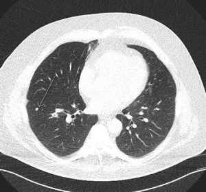 lung imaging low dose screening ct